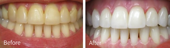 Before and after treatment with crowns